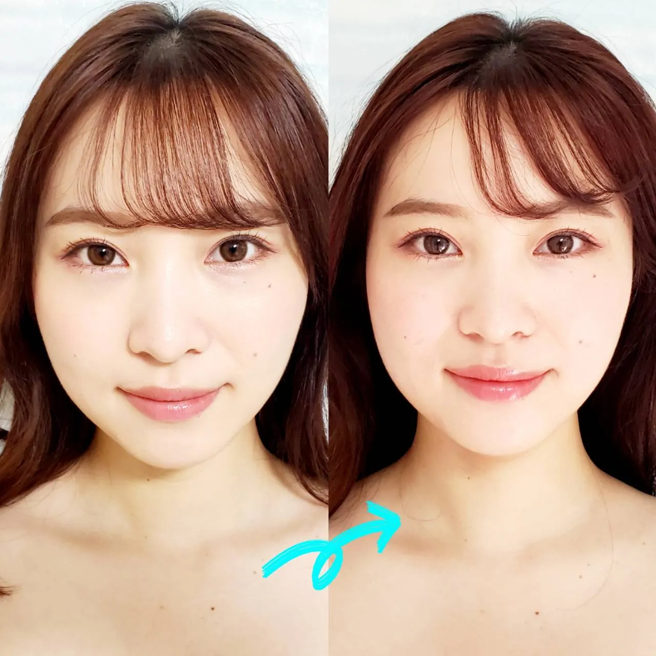 【人気No.1】シンデレラ美顔针(美顔矯正)の施術イメージ
