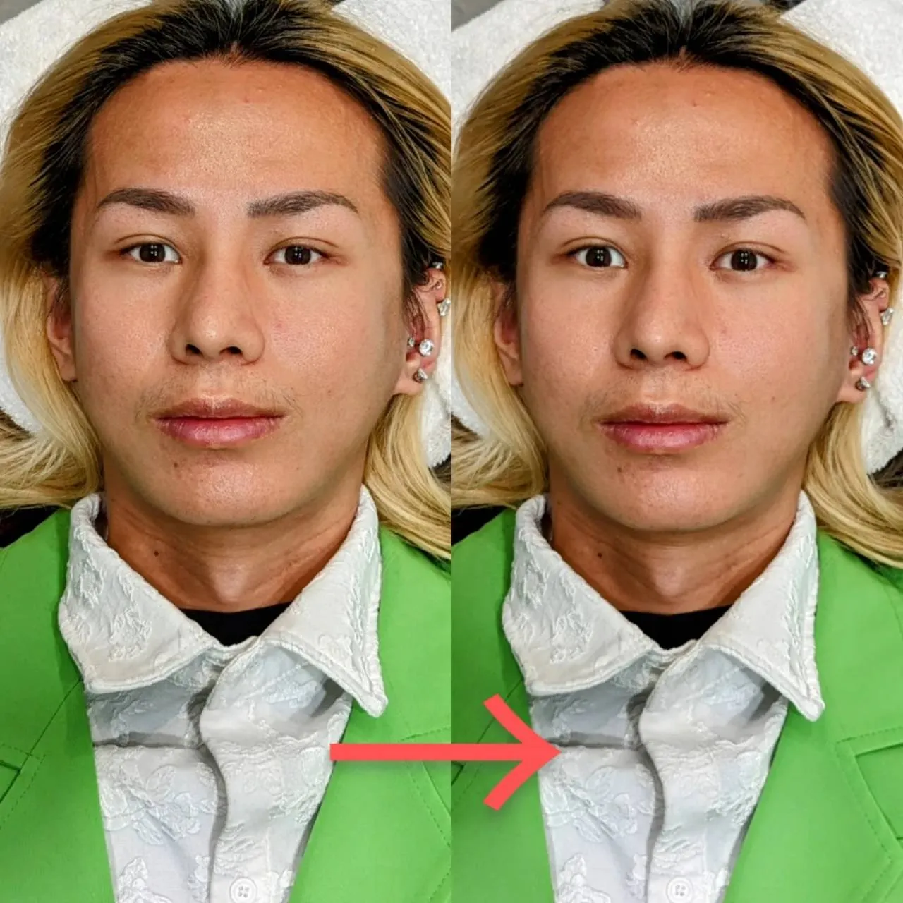 小顔针イケメン(美男)の施術イメージ