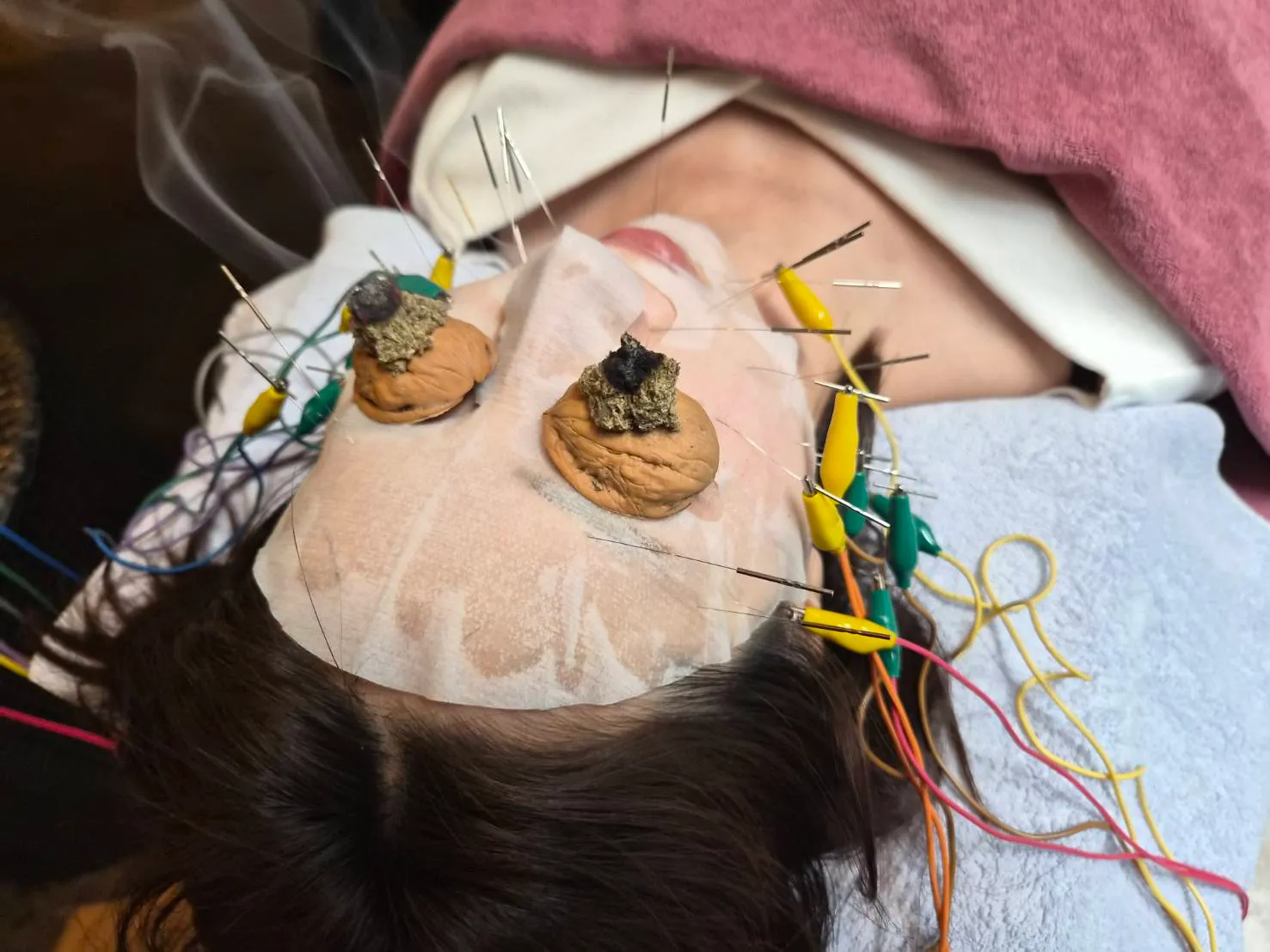 ヒト幹細胞美容電気针&くるみ灸(極上肌)の施術イメージ